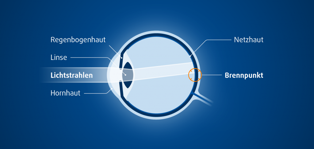 Hornhautverkrümmung lasern lassen am Auge erklärt